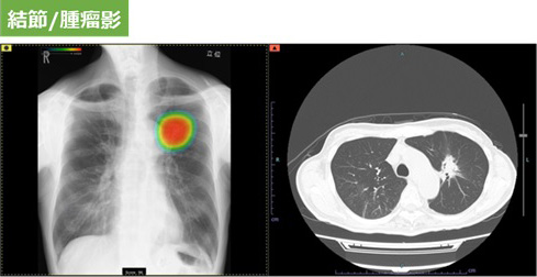 胸部X線画像病変検出ソフトウェア CXR-AID