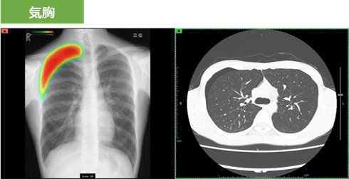 胸部X線画像病変検出ソフトウェア CXR-AID