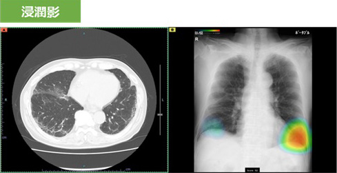 胸部X線画像病変検出ソフトウェア CXR-AID