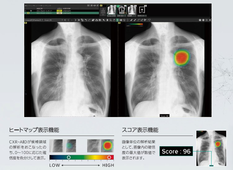 胸部X線画像病変検出ソフトウェア CXR-AID